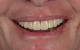 Implant dentistry example 1 photo 2