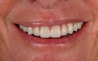Implant dentistry example 1 photo 3