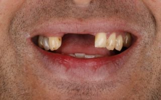 Implant dentistry example 3 photo 1