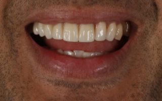 Implant dentistry example 3 photo 2