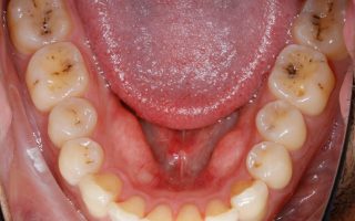 Tooth wear example 1 photo 1
