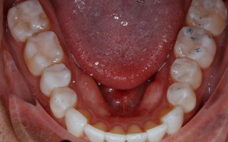 Tooth wear example 1 photo 2