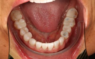Tooth wear example 2 photo 1