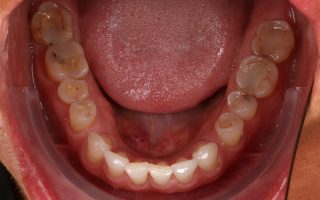 Tooth wear example 2 photo 1(1)