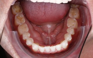 Tooth wear example 3 photo 1