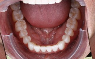 Tooth wear example 3 photo 2